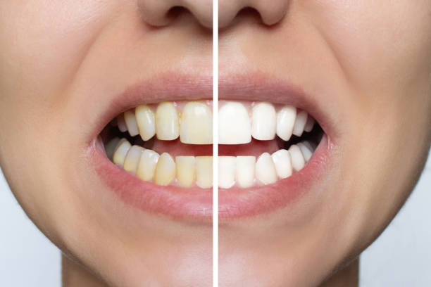 istock Women's teeth whitening close-up before and after the procedure 1798596521