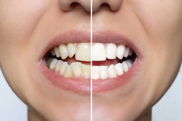 istock Young woman's smile before and after teeth straightening 1798607620
