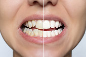 Young woman's smile before and after teeth straightening