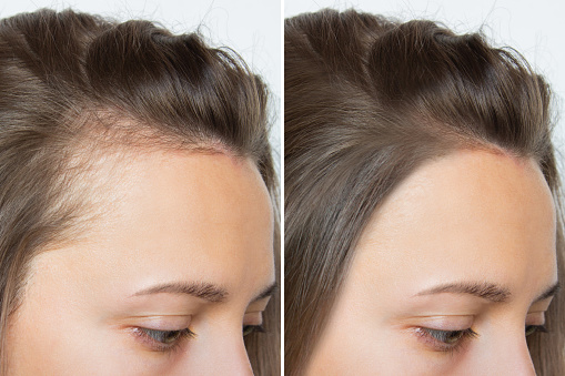 Cropped before and after head shot of a young woman with bald patches on her forehead and temples. Baldness. Close-up, side view. Hair care and treatment concept. Hair loss, hair extensions, alopecia.
