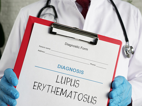 Systemic Lupus Erythematosus SLE or Lupus Erythematosus LE is shown using a text