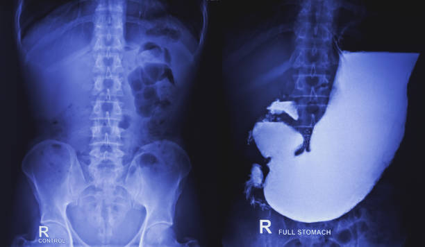 бариевая мука и контрольный осмотр рентгеном. показание пищеварительной системы. большая часть желудка, толстая кишка, такая как поперечна - descending colon стоковые фото и изображения