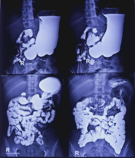 бариевая мука и контрольный осмотр рентгеном. показание пищеварительной системы. большая часть желудка, толстая кишка, такая как поперечна - descending colon стоковые фото и изображения