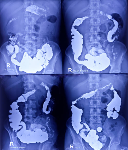 istock Barium meal and follow through examination x-ray. showing digestive system. most part of stomach, large intestine such as transverse colon, sigmoid colon and rectum. Normal findings. 1800265876