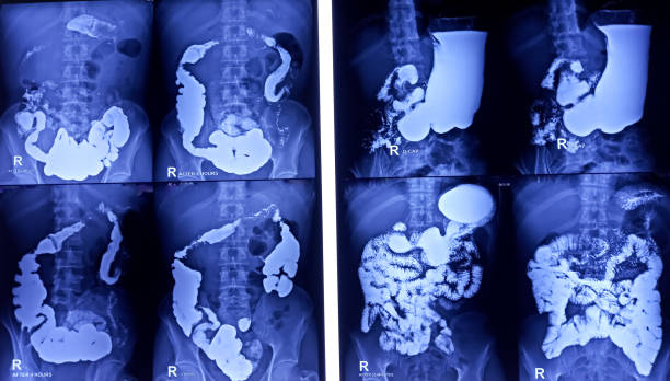 istock Barium meal and follow through examination x-ray. showing digestive system. most part of stomach, large intestine such as transverse colon, sigmoid colon and rectum. Normal findings. 1800266384