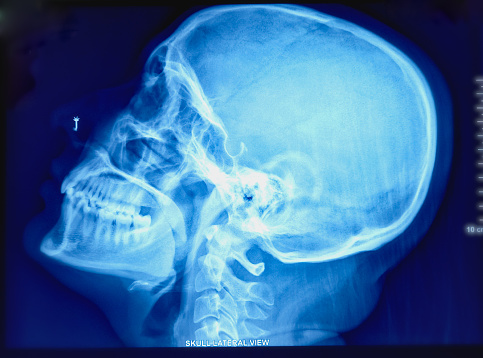 X-RAY SKULL AP and LATERAL VIEW. No remarkable abnormality detected. The calvaria is of normal thickness. Sella turcica is normal in both dimensions and configuration.