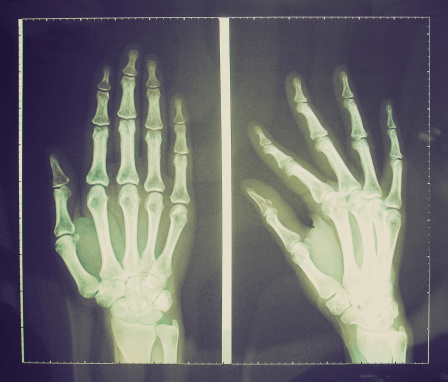 Vintage looking Medical X-Ray imaging of hand fingers used in diagnostic radiology of skeleton bones