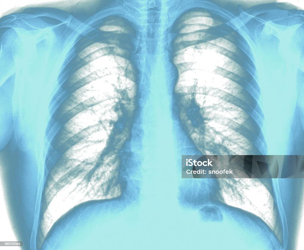 Immagine a raggi X del torace sano - Foto stock royalty-free di Anatomia umana