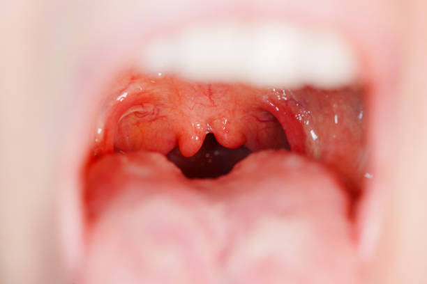 istock Cleft, bifurcation of the uvula. malformations. 1801742125