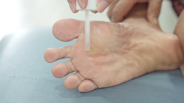 Elderly Foot Care: Salicylic Acid Treatment for Corns & Calluses