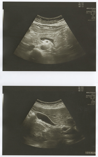 Clockwise, axial and sagittal T1 post contrast, then sagittal and axial T2 MRI of the pelvis with a large (11 cm) uterine fibroid with central necrosis, compressing the urinary bladder and rectum. Uterine fibroids are common benign tumors of the uterus that first appear during fertile years and grow with hormonal stimulation until menopause. They can be tiny and go unnoticed or grow as large as a full-term baby. In addition to expanding the waistline, fibroids can cause prolonged, heavy menstrual bleeding and pain, pelvic pain, and pressure on the bladder and rectum leading to difficulty with passing bowel movements and frequent urination. They can impair venous blood flow out of the legs, causing leg pain and heaviness. Most fibroids can be treated with a non-invasive procedure where the blood supply is cut off through a catheter threaded from the femoral artery into the uterine artery, termed uterine artery embolization or uterine fibroid embolization, performed by an interventional radiologist.