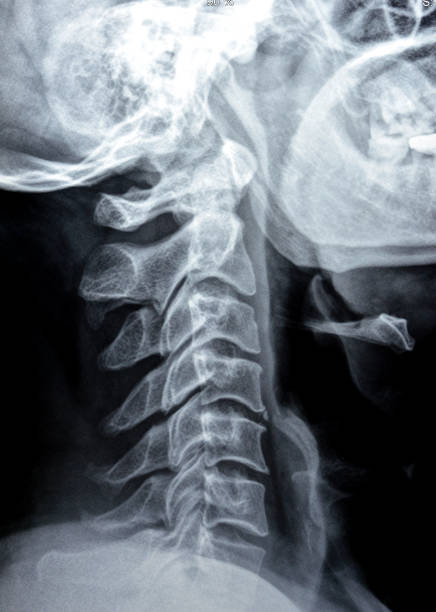istock Plain X ray of cervical spine revealed straightened cervical curve, spondylosis osteophytic lipping of C3, C4, C5 vertebral end plates, narrow disc spaces, ligamentous calcification opposing C4, C5 1802563481
