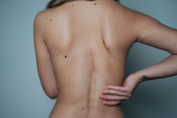 Back pain after surgery scoliosis Back pain after surgery scoliosis scar surgery rear view human spine stock pictures, royalty-free photos & images