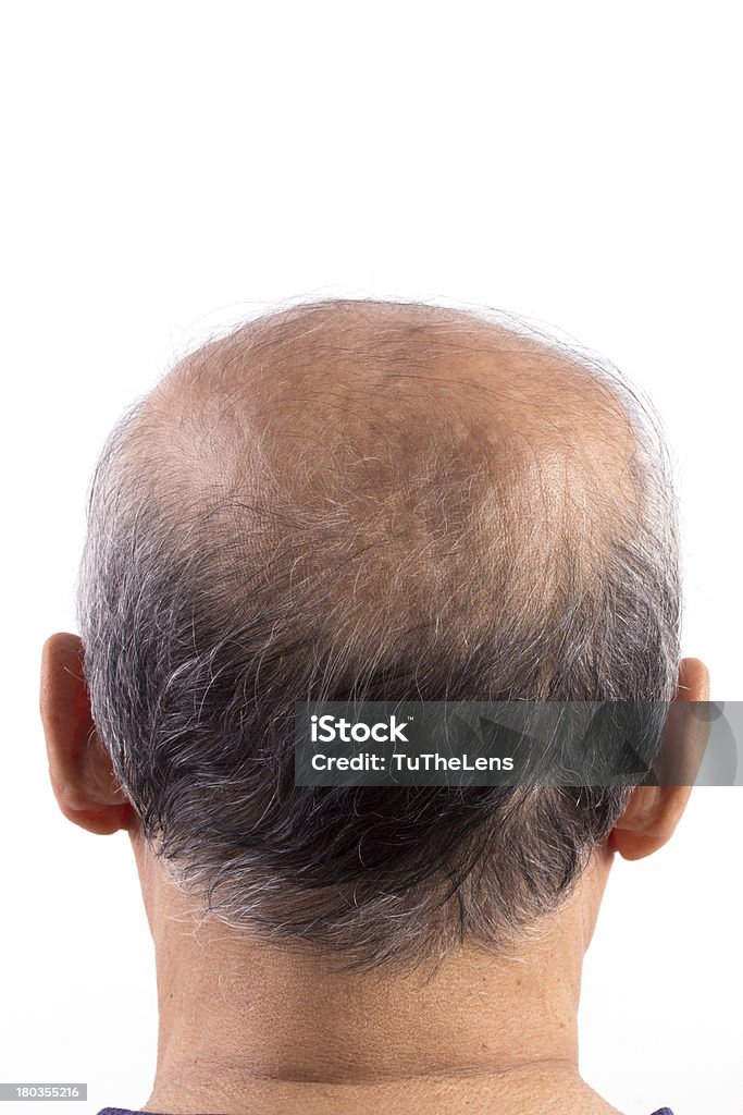 Homem Careca perda de cabelo - Royalty-free Acomia Foto de stock