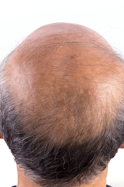 istock hair loss bald man 180356289