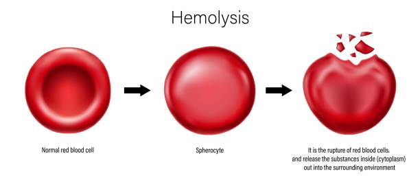 적혈구의 용혈. 정상적인 적혈구, 구상세포, 적혈구 파열. - blood cell anemia cell structure red blood cell stock illustrations