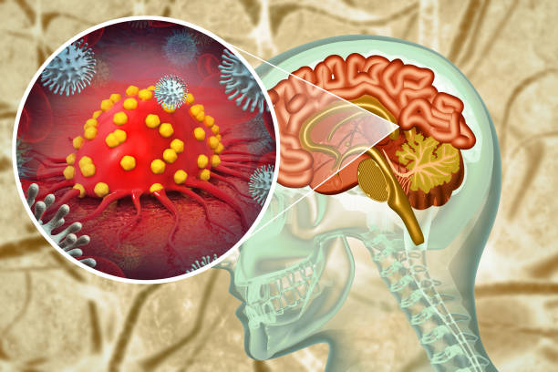istock Brain cancer. Cancer cells attacking the human brain. 3d illustration 1804025762