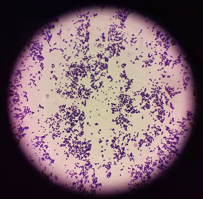 Gram stain of the bacterium, Staphylococcus aureus. This bacteria is gram positive, as such it appears purple after staining due to the thick peptidoglycan. The round cells are also seen in clusters.