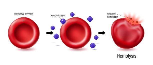 wektor hemolizy. proces niszczenia czerwonych krwinek. prawidłowa czerwona krwinka ze środkiem hemolitycznym i pęknięcie erytrocytów. - blood cell anemia cell structure red blood cell stock illustrations