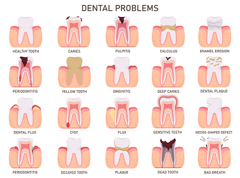 Teeth medical problem dental disease design element vector illustration set. Healthy tooth, caries, pulpitis, calculus, enamel erosion, periodontitis, gingivitis, plaque, cyst, fluxbead breath