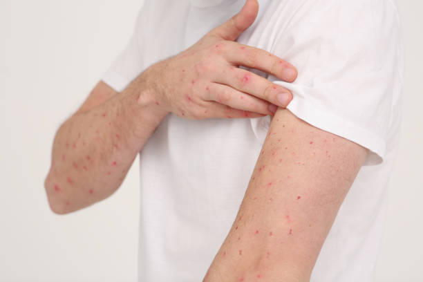 istock Man with rash suffering from monkeypox virus on beige background, closeup 1806469253