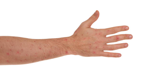istock Man with rash suffering from monkeypox virus on white background, closeup 1806470317