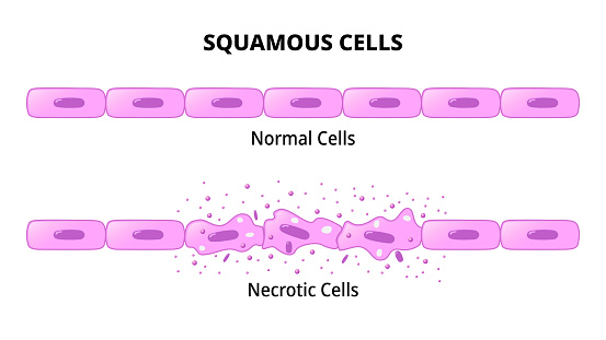 Nectrotic Cells Squamous Cells Normal Epithelial Cell Necrotic Cell Stock Illustration ...