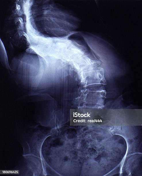 Imagen De Rayos X Dogleg Columna Vertebral Humana Foto de stock y más banco de imágenes de Articulación - Articulación, Cadera, Dolor