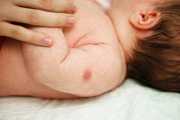 istock Baby's hand - vaccine against tuberculosis 180715275