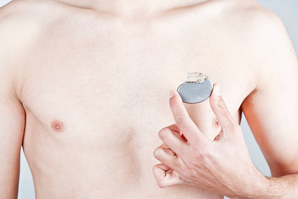 심장 박동조율기 - pacemaker torso chest male 뉴스 사진 이미지