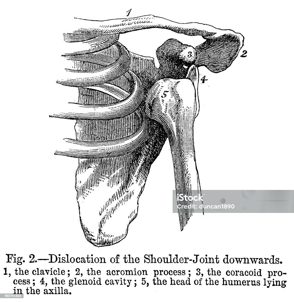 Luxación articular del hombro - Ilustración de stock de Grabado - Técnica de ilustración libre de derechos