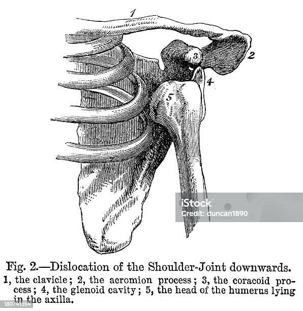 Ilustración de Luxación Articular Del Hombro y más Vectores Libres de Derechos de Grabado - Técnica de ilustración - Grabado - Técnica de ilustración, Hombro, Abducción del hombro