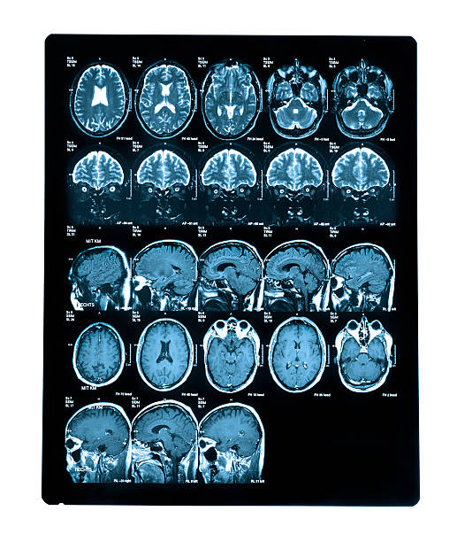 scanner de tête humaine - corpus striatum photos et images de collection