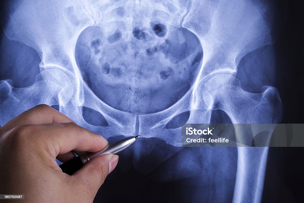 Diagnostiquer les bassin x-ray - Photo de Aine libre de droits