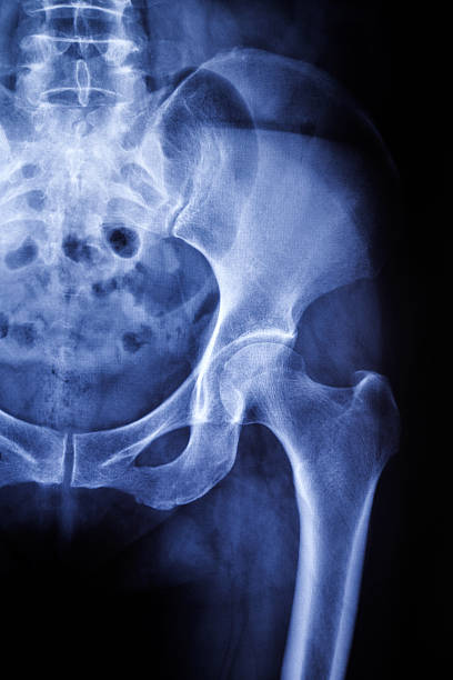 ヒト骨盤 x 線:onfh の標識 - cat scan pelvis hip human spine ストックフォトと画像