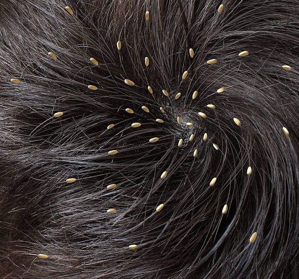 Close-up of someone's head infested with head lice Head lice medical concept with a close up of a human head with an infestation of parasitic nits or eggs hatching near the scalp from a louse as a symbol of  diagnosis prevention and treatment for children and adults. parasite infestation stock pictures, royalty-free photos & images