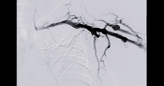 Which Endovascular Procedure Reopens Narrowed Blood Vessels Balloon Angioplasty Is A Medical Procedure Used To Widen Narrowed Or