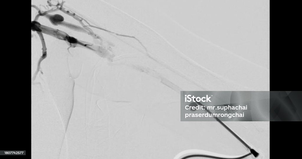 Which Endovascular Procedure Reopens Narrowed Blood Vessels Balloon Angioplasty Is A Medical Procedure Used To Widen Narrowed Or