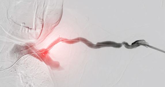 Which Endovascular Procedure Reopens Narrowed Blood Vessels Balloon Angioplasty Is A Medical Procedure Used To Widen Narrowed Or