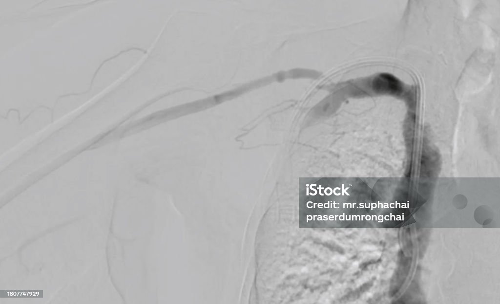 Which Endovascular Procedure Reopens Narrowed Blood Vessels Balloon Angioplasty Is A Medical Procedure Used To Widen Narrowed Or