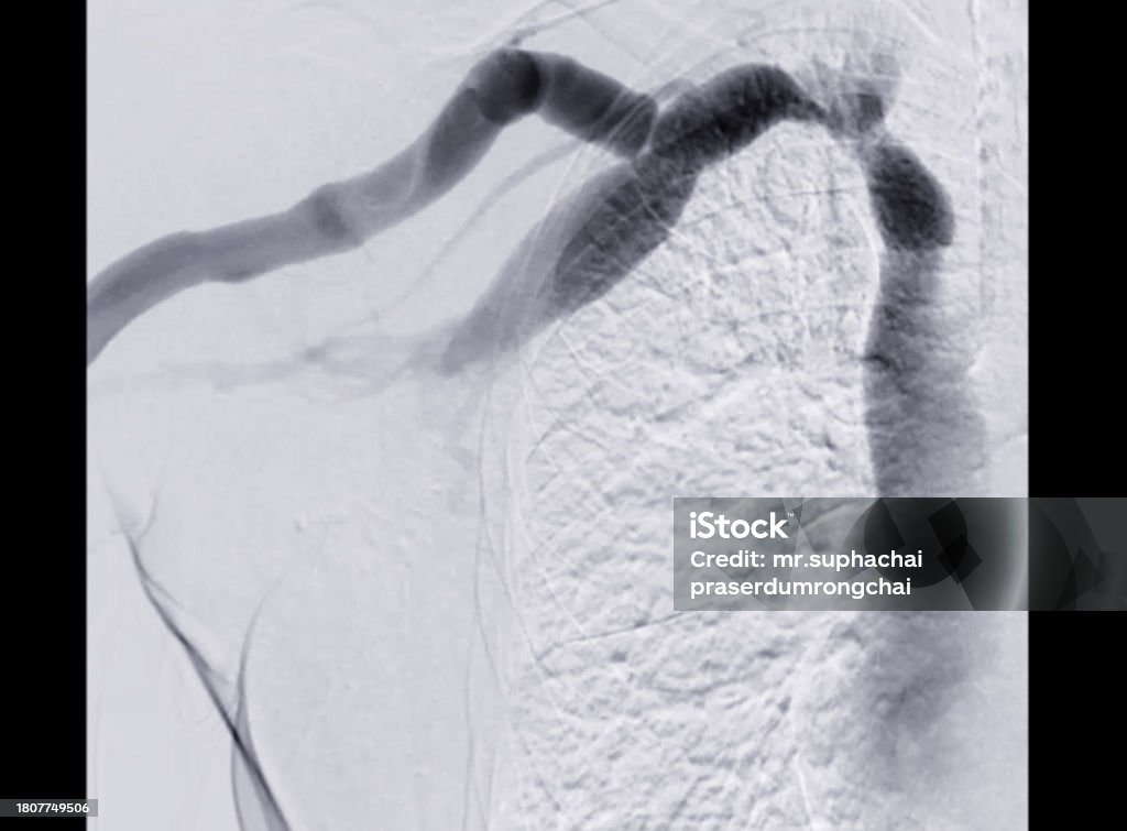 Which Endovascular Procedure Reopens Narrowed Blood Vessels Balloon Angioplasty Is A Medical Procedure Used To Widen Narrowed Or