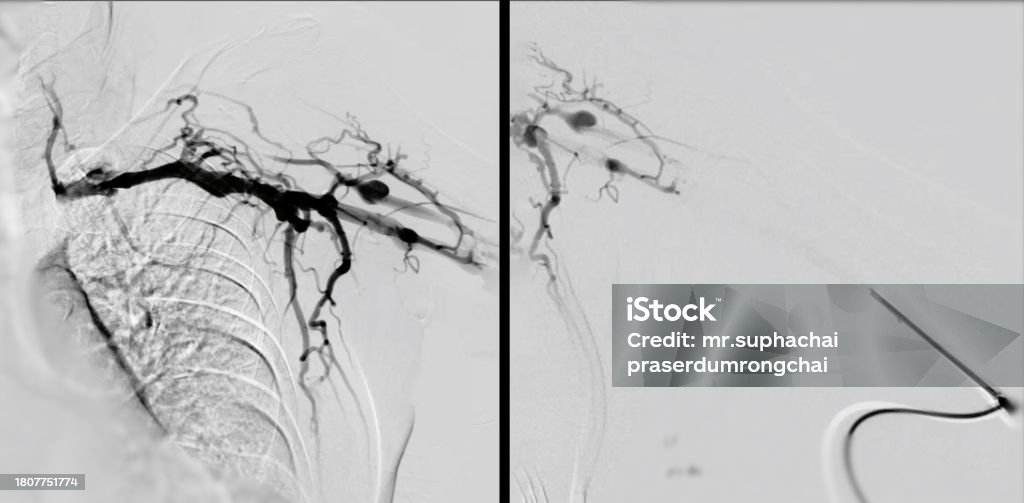 Which Endovascular Procedure Reopens Narrowed Blood Vessels Balloon Angioplasty Is A Medical Procedure Used To Widen Narrowed Or