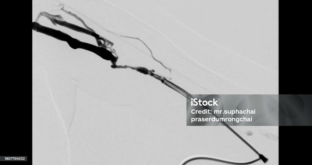 Which Endovascular Procedure Reopens Narrowed Blood Vessels Balloon Angioplasty Is A Medical Procedure Used To Widen Narrowed Or
