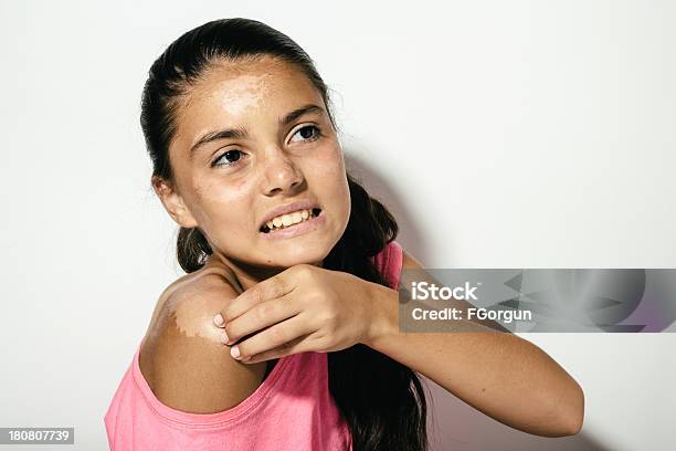 Chica Adolescente Quemaduras De Sol Y Descamación De La Piel Foto de stock y más banco de imágenes de Adolescente
