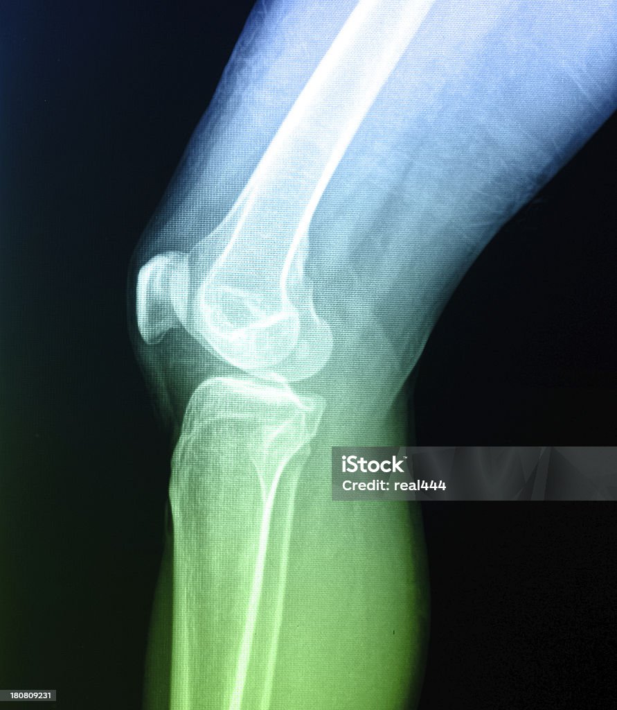 Genou humain anatomie X-Ray Os de la jambe - Photo de Scanographie libre de droits