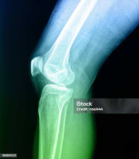 Radiografie Ossee Ginocchio Umano Anatomia Della Gamba - Fotografie stock e altre immagini di Scansione medica