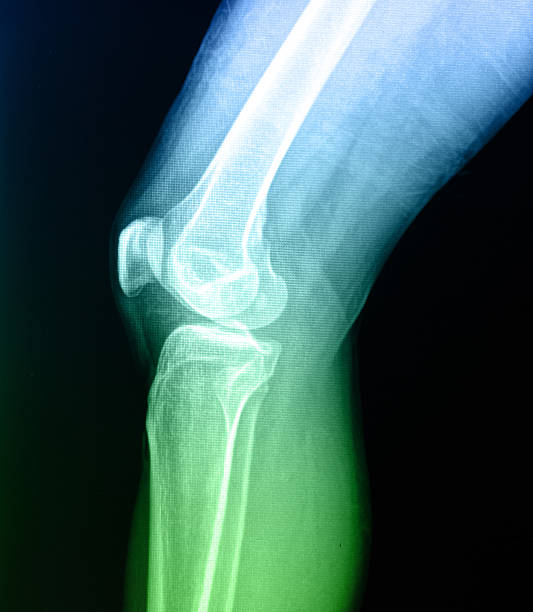 膝の部位の x 線骨人の脚 - cartilage patella human knee medical exam ストックフォトと画像