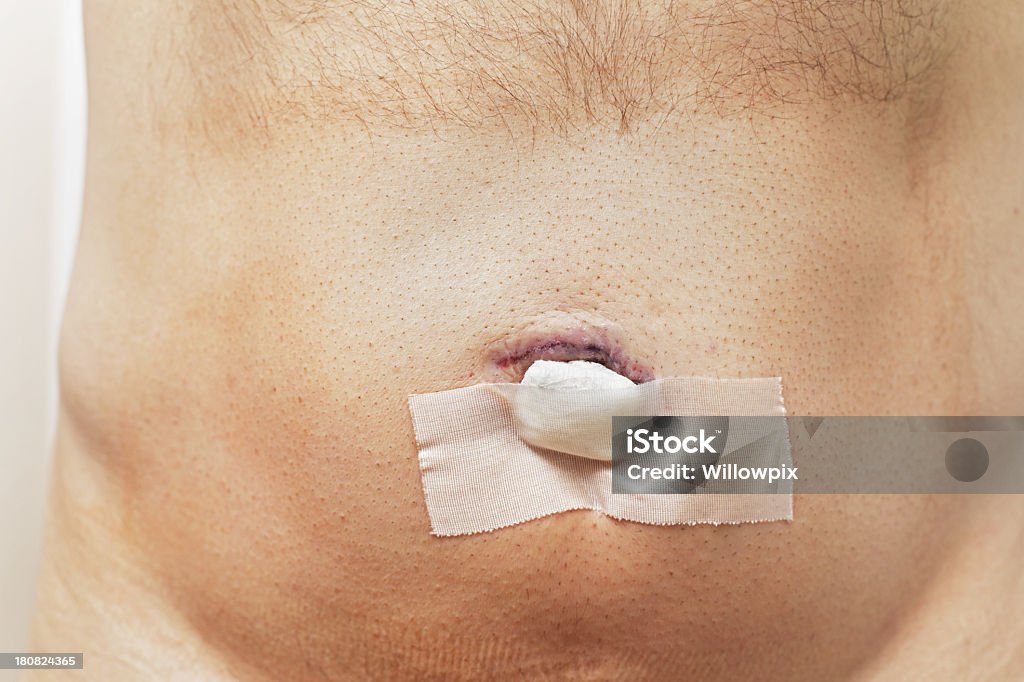 Bandaged nach der Operation Umbilical Hernia - Lizenzfrei Eingeweidebruch Stock-Foto