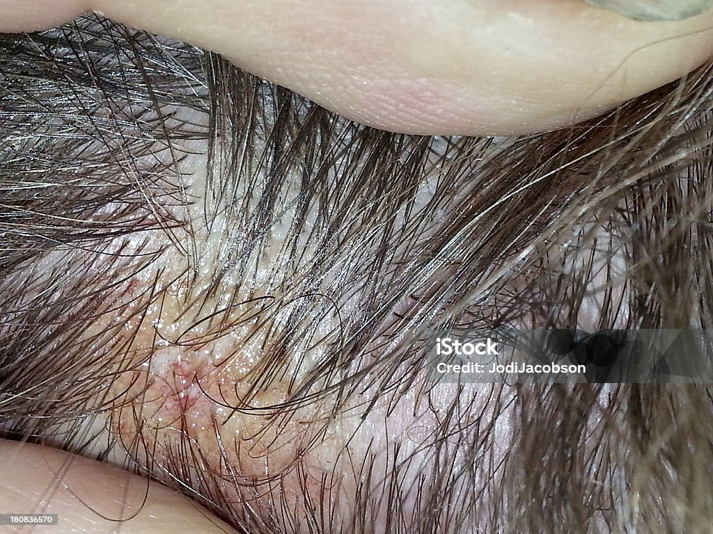 Mobil Stock Medical Infected Hair Follicle On A Mans Head Stock Photo -  Download Image Now - iStock