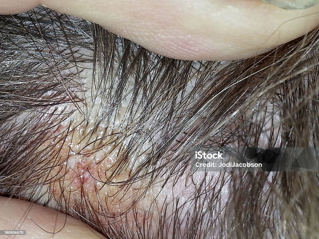 Mobil Stock Medical Infected Hair Follicle On A Mans Head Stock Photo - Download Image Now - iStock Mobil Stock Medical Infected Hair Follicle On A Mans Head Stock Photo - Download Image Now - iStock